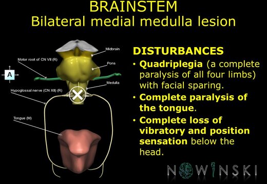 G11.T9.RegionalAnatomyDisorders.Brainstem.Medulla bilateral medial lesion