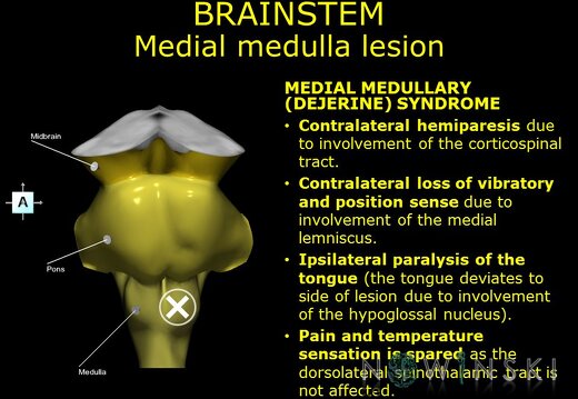 G11.T9.RegionalAnatomyDisorders.Brainstem.Medulla medial lesion