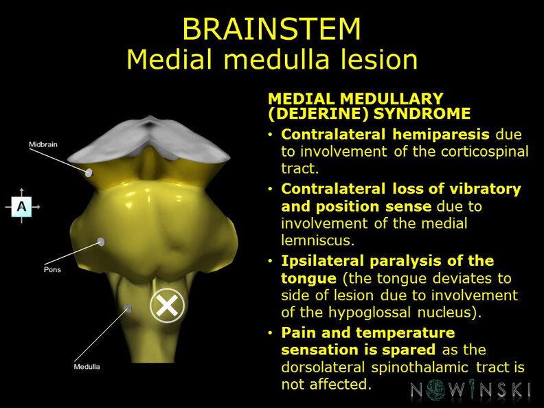 G11.T9.RegionalAnatomyDisorders.Brainstem.Medulla_medial_lesion.TIF