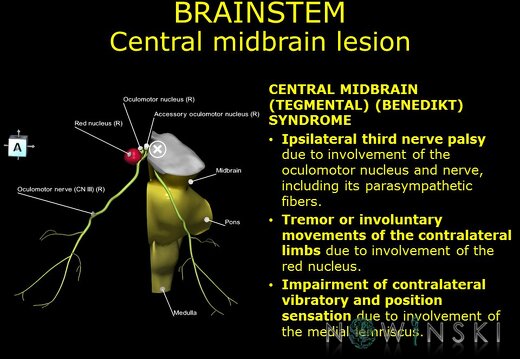 G11.T9.RegionalAnatomyDisorders.Brainstem.Midbrain central lesion