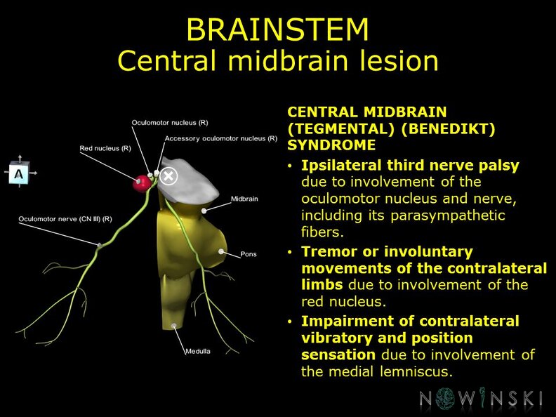 G11.T9.RegionalAnatomyDisorders.Brainstem.Midbrain_central_lesion.TIF