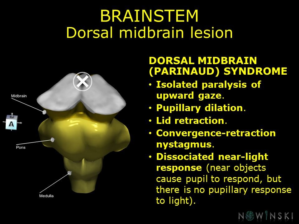 G11.T9.RegionalAnatomyDisorders.Brainstem.Midbrain dorsal lesion