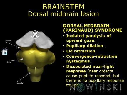 G11.T9.RegionalAnatomyDisorders.Brainstem.Midbrain dorsal lesion