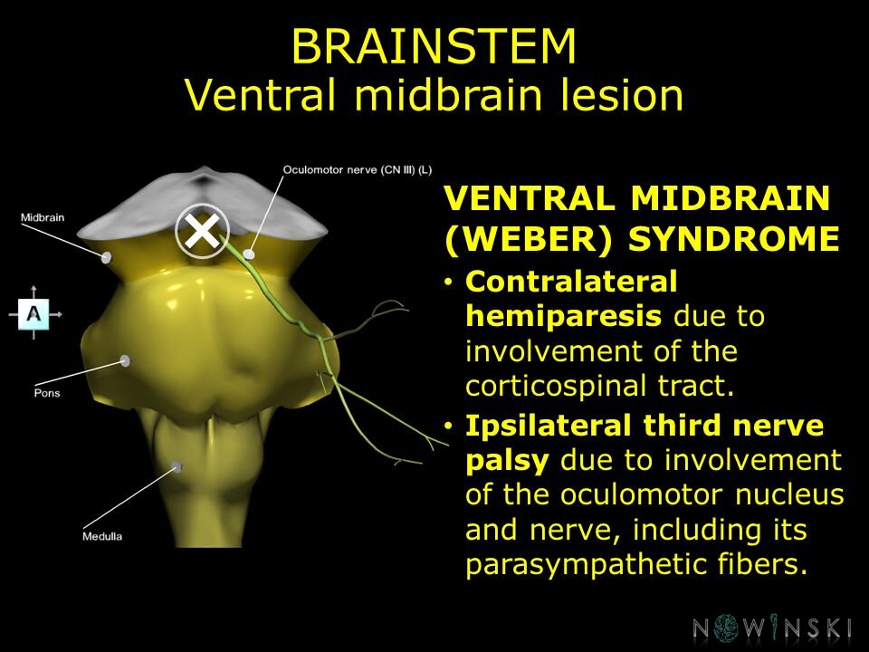 G11.T9.RegionalAnatomyDisorders.Brainstem.Midbrain ventral lesion