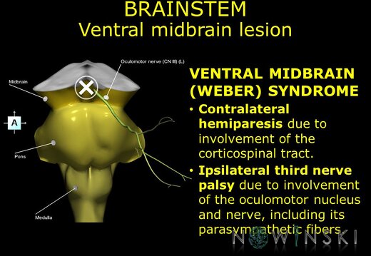 G11.T9.RegionalAnatomyDisorders.Brainstem.Midbrain ventral lesion