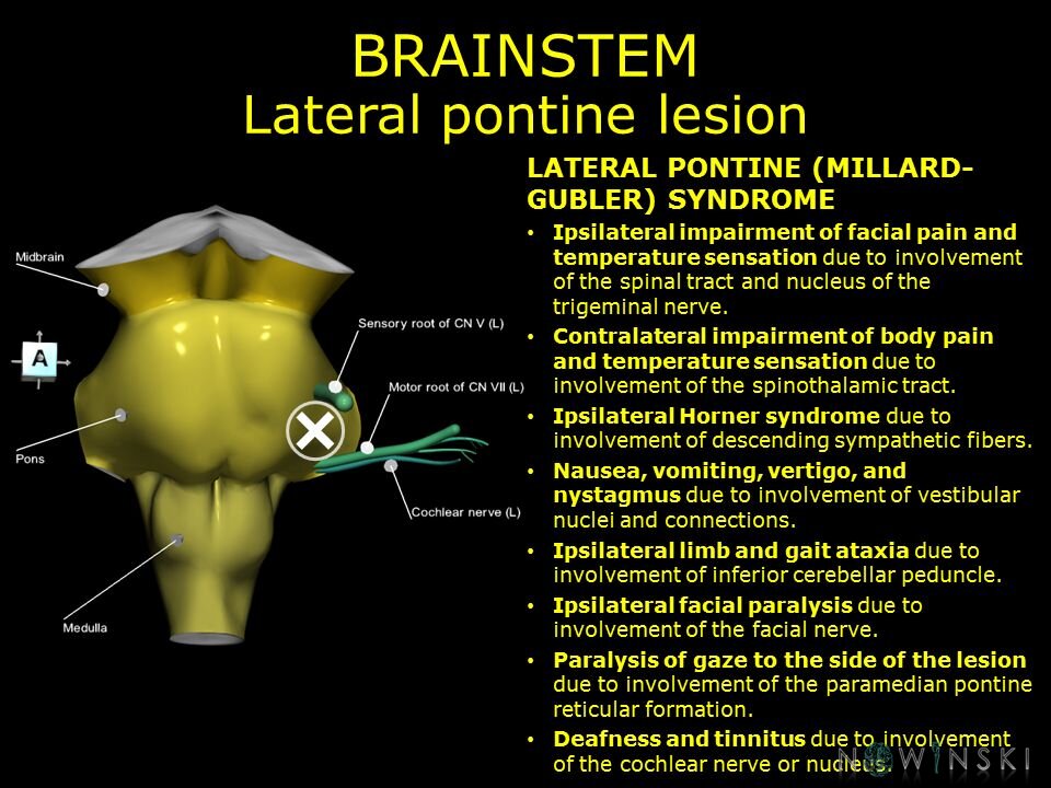 G11.T9.RegionalAnatomyDisorders.Brainstem.Pons lateral lesion