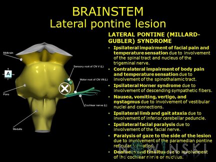 G11.T9.RegionalAnatomyDisorders.Brainstem.Pons lateral lesion