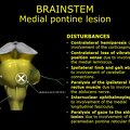 G11.T9.RegionalAnatomyDisorders.Brainstem.Pons medial lesion