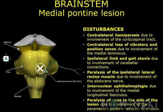 G11.T9.RegionalAnatomyDisorders.Brainstem.Pons medial lesion