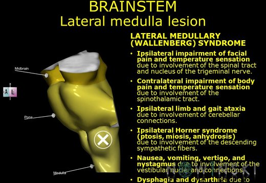 G11.T9.RegionalAnatomyDisorders.Lateral medulla lesion