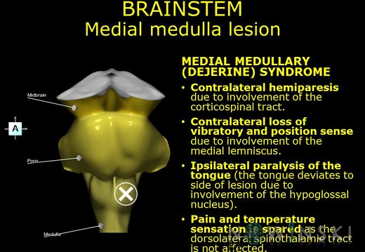 G11.T9.RegionalAnatomyDisorders.Medial medulla lesion