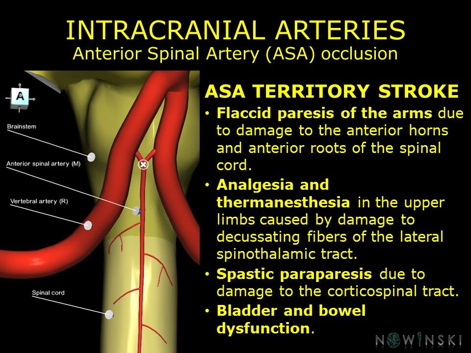G11.T15.10.VascularDisorders.VertebralArtery.Anterior spinal artery occlusion