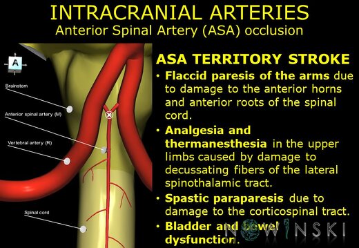 G11.T15.10.VascularDisorders.VertebralArtery.Anterior spinal artery occlusion