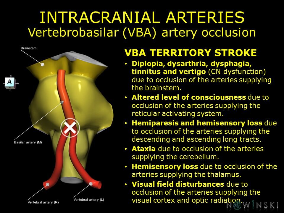 G11.T15.10.VascularDisorders.VertebralArtery.Vertebrobasilar artery occlusion