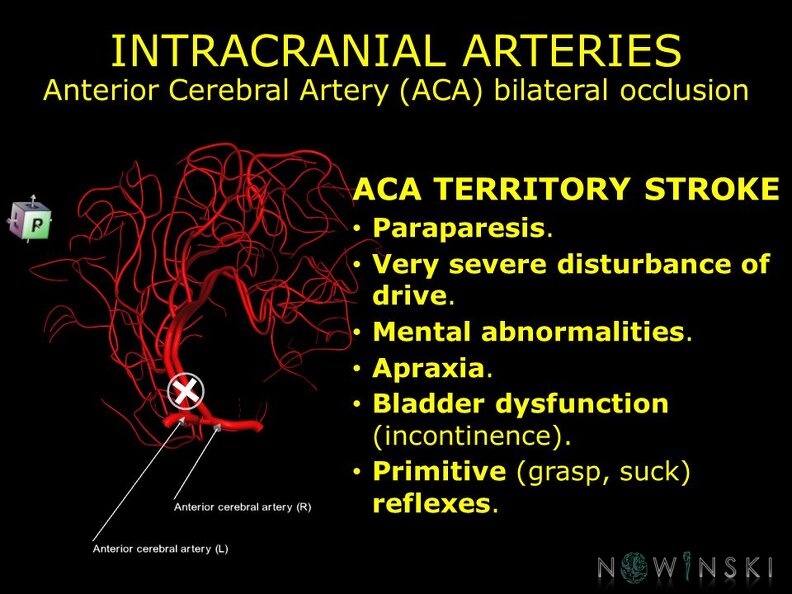 G11.T15.5.VascularDisorders.AnteriorCerebralArtery.Anterior_cerebral_artery_bilateral_occlusion.TIF