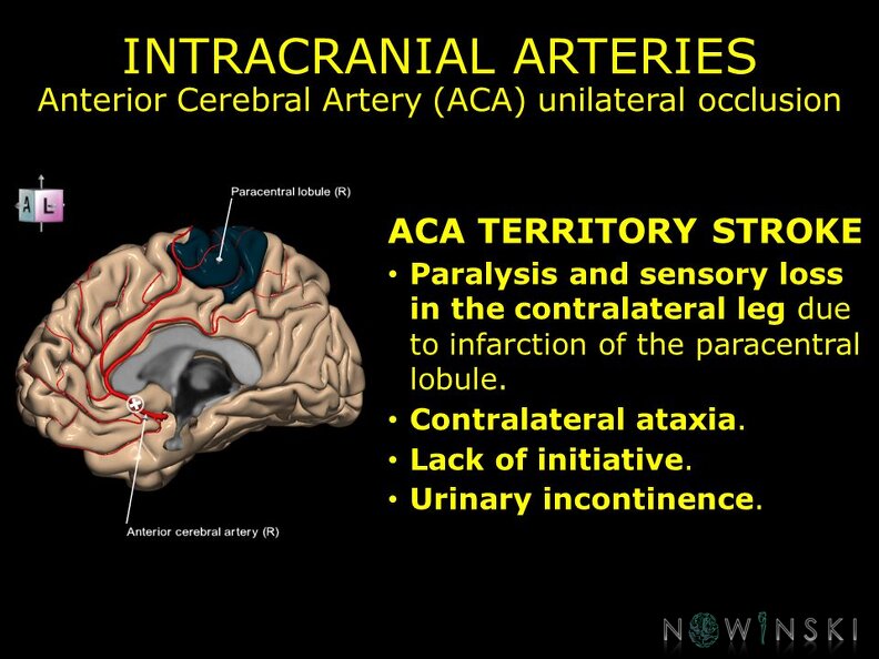 G11.T15.5.VascularDisorders.AnteriorCerebralArtery.Anterior cerebral artery unilateral occlusion