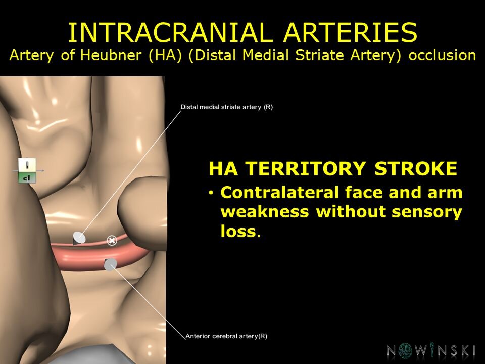 G11.T15.5.VascularDisorders.AnteriorCerebralArtery.Artery of Heubner occlusion