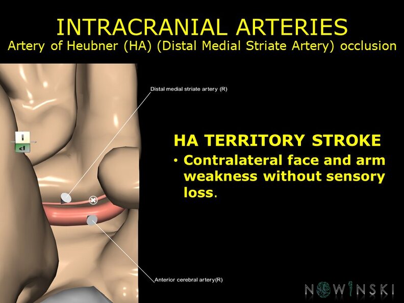G11.T15.5.VascularDisorders.AnteriorCerebralArtery.Artery_of_Heubner_occlusion.TIF