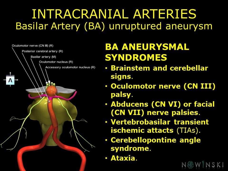 G11.T15.6.VascularDisorders.BasilarArtery.Basilar artery unruptured aneurysm