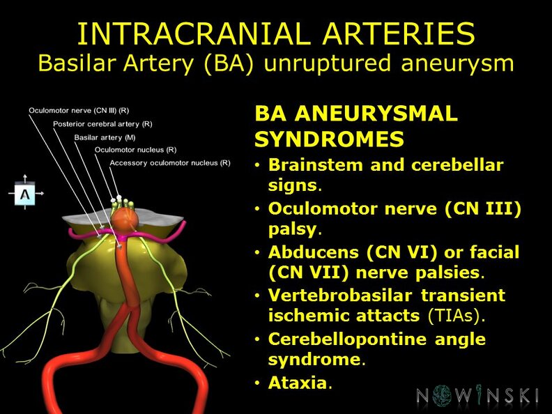 G11.T15.6.VascularDisorders.BasilarArtery.Basilar_artery_unruptured_aneurysm.TIF