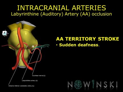 G11.T15.6.VascularDisorders.BasilarArtery.Labyrinthine artery occlusion