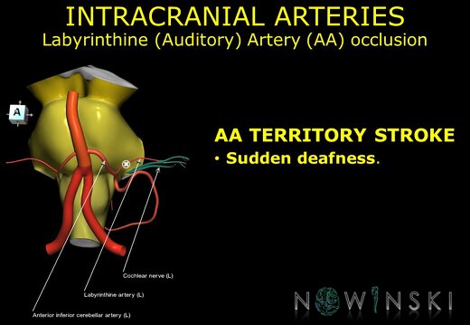 G11.T15.6.VascularDisorders.BasilarArtery.Labyrinthine artery occlusion
