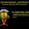 G11.T15.6.VascularDisorders.BasilarArtery.Pontine arteries occlusion