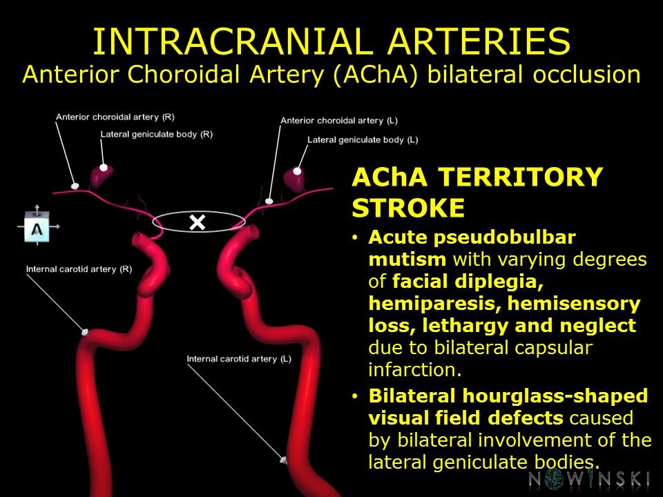 G11.T15.7.VascularDisorders.InternalCarotidArtery.Anterior choroidal artery bilateral occlusion