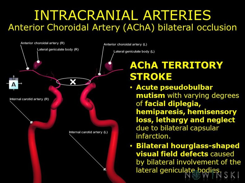 G11.T15.7.VascularDisorders.InternalCarotidArtery.Anterior_choroidal_artery_bilateral_occlusion.TIF