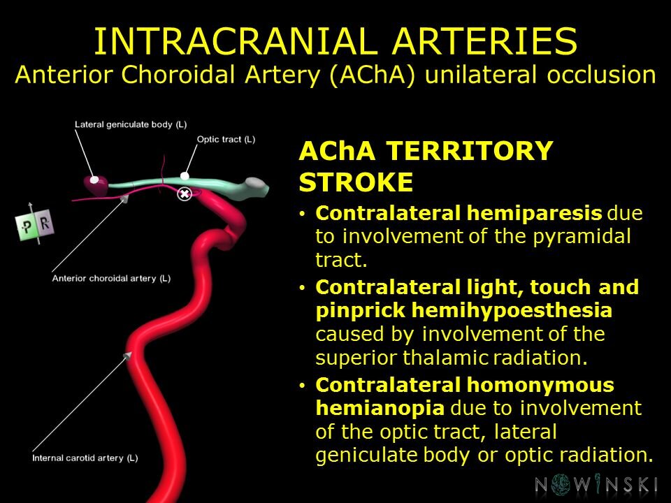 G11.T15.7.VascularDisorders.InternalCarotidArtery.Anterior choroidal artery unilateral occlusion