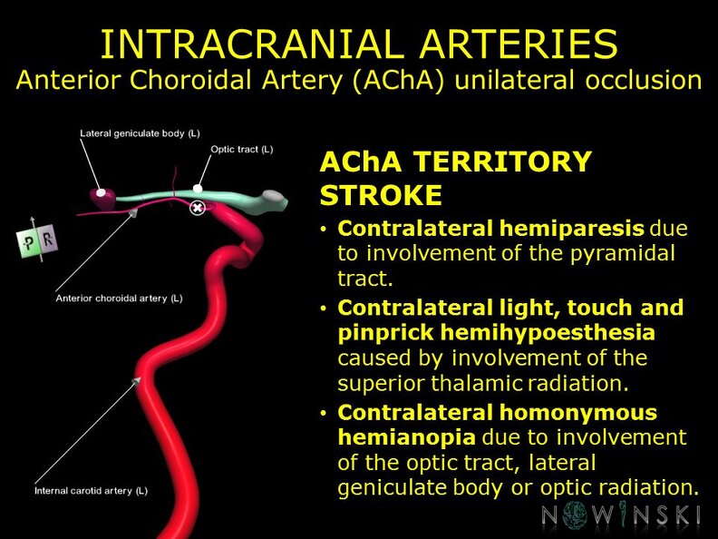 G11.T15.7.VascularDisorders.InternalCarotidArtery.Anterior_choroidal_artery_unilateral_occlusion.TIF