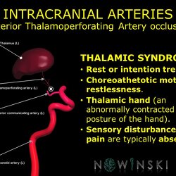 G11.T15.7.VascularDisorders.InternalCarotidArtery.Anterior thalamoperforating artery occlusion