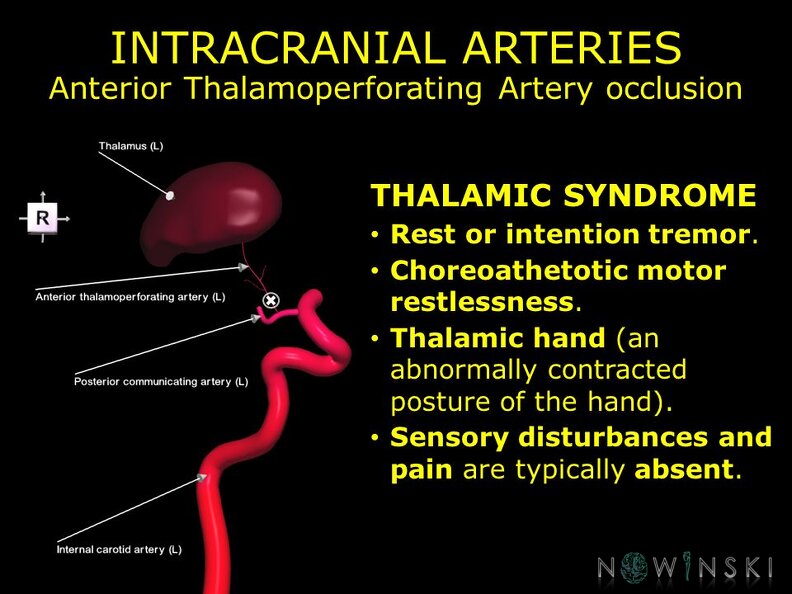 G11.T15.7.VascularDisorders.InternalCarotidArtery.Anterior_thalamoperforating_artery_occlusion.TIF