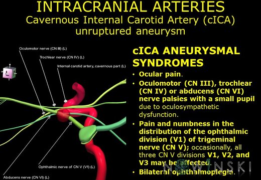 G11.T15.7.VascularDisorders.InternalCarotidArtery.Cavernous internal carotid artery unruptured aneurysm