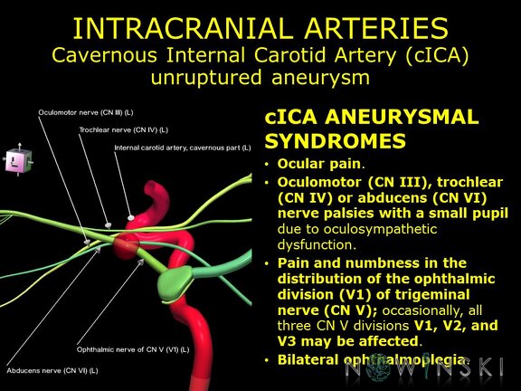 G11.T15.7.VascularDisorders.InternalCarotidArtery.Cavernous internal carotid artery unruptured aneurysm