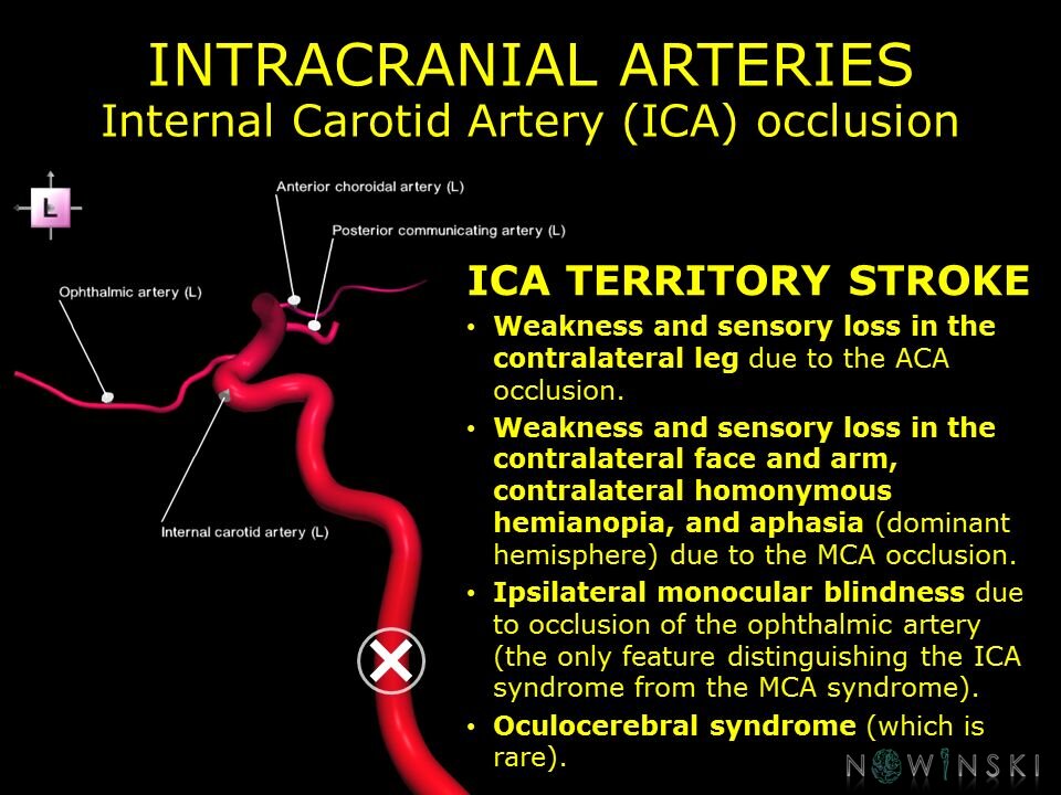 G11.T15.7.VascularDisorders.InternalCarotidArtery.Internal carotid artery occlusion