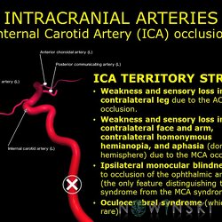 G11.T15.7.VascularDisorders.InternalCarotidArtery.Internal carotid artery occlusion