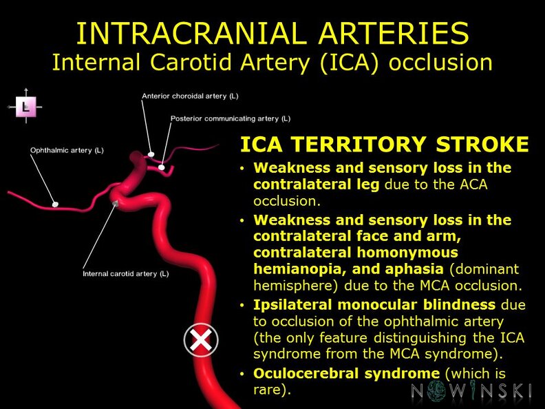 G11.T15.7.VascularDisorders.InternalCarotidArtery.Internal_carotid_artery_occlusion.TIF