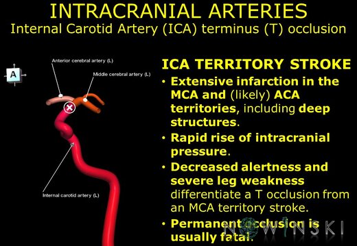 G11.T15.7.VascularDisorders.InternalCarotidArtery.Internal carotid artery terminus occlusion