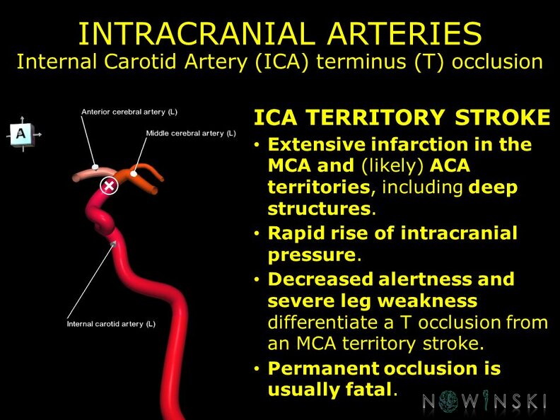 G11.T15.7.VascularDisorders.InternalCarotidArtery.Internal_carotid_artery_terminus_occlusion.TIF