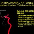 G11.T15.7.VascularDisorders.InternalCarotidArtery.Ophthalmic artery occlusion
