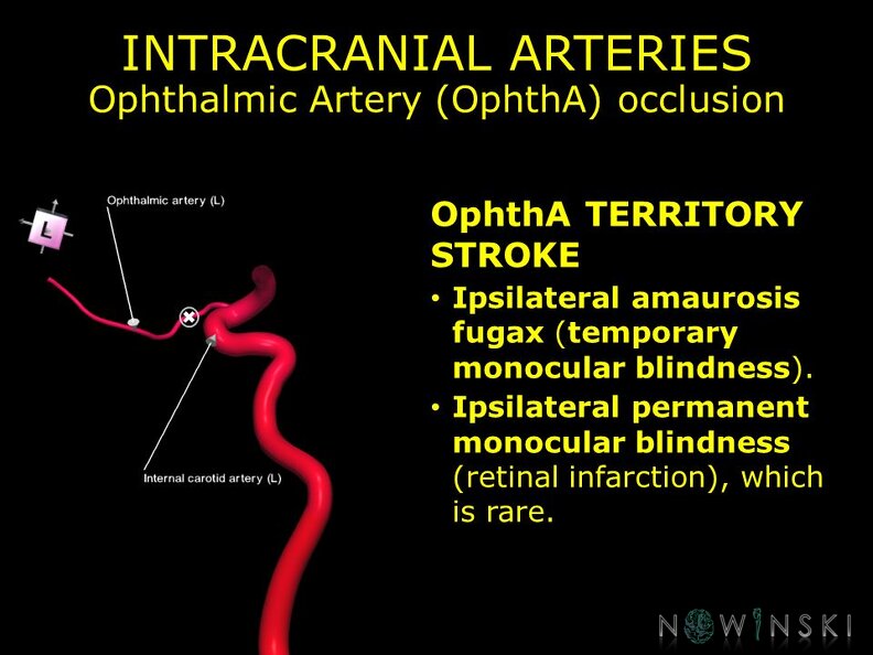 G11.T15.7.VascularDisorders.InternalCarotidArtery.Ophthalmic artery occlusion
