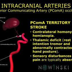 G11.T15.7.VascularDisorders.InternalCarotidArtery.Posterior communicating artery occlusion