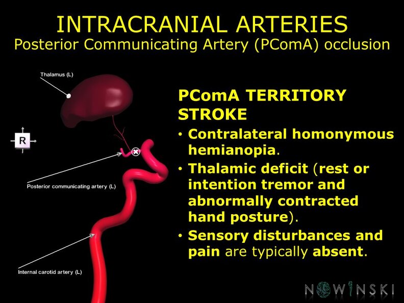 G11.T15.7.VascularDisorders.InternalCarotidArtery.Posterior_communicating_artery_occlusion.TIF