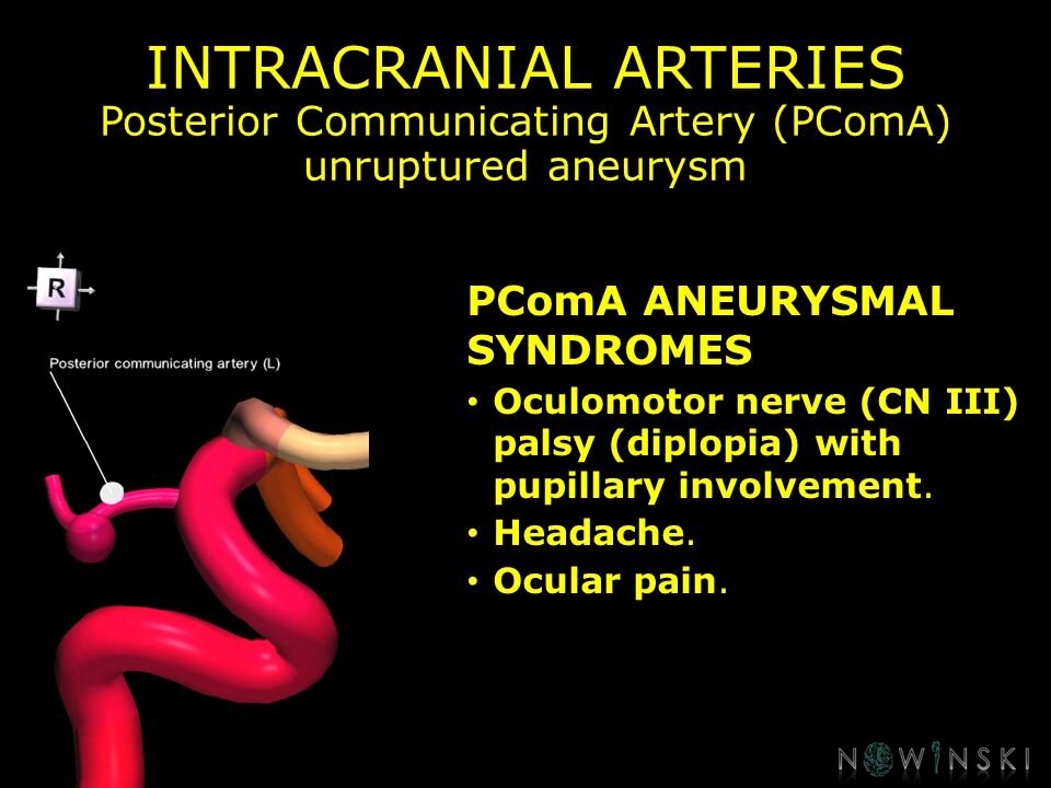 G11.T15.7.VascularDisorders.InternalCarotidArtery.Posterior communicating artery unruptured aneurysm
