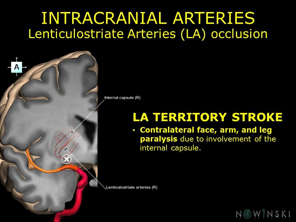 G11.T15.8.VascularDisorders.MiddleCerebralArtery.Lenticulostriate arteries occlusion