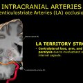 G11.T15.8.VascularDisorders.MiddleCerebralArtery.Lenticulostriate arteries occlusion
