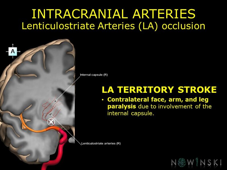 G11.T15.8.VascularDisorders.MiddleCerebralArtery.Lenticulostriate_arteries_occlusion.TIF
