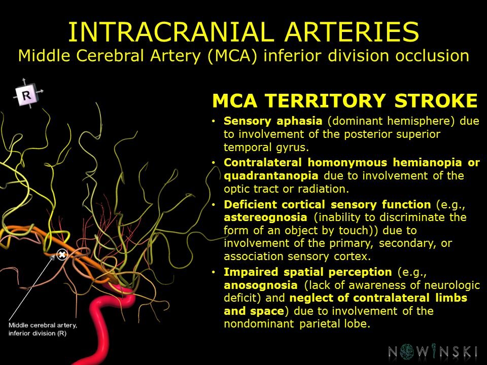 G11.T15.8.VascularDisorders.MiddleCerebralArtery.Middle cerebral artery inferior division occlusion