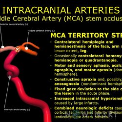 G11.T15.8.VascularDisorders.MiddleCerebralArtery.Middle cerebral artery stem occlusion